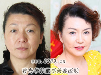 李東風(fēng)彩光嫩膚祛黃褐斑前后對比照片