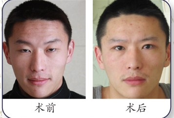 陽光肉毒素注射除額頭紋前后對比照片