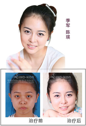 陳瑛頦部填充前后對(duì)比照片