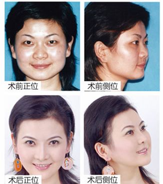 湯永花去眼袋前后對(duì)比照片