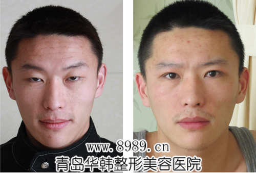陽(yáng)光上瞼下垂矯正前后對(duì)比照片