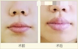 薄唇變厚整形前后對比照片
