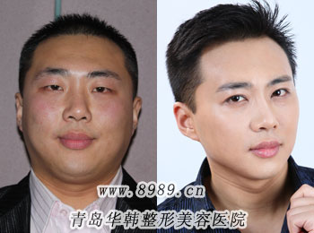 怎樣快速減掉雙下巴