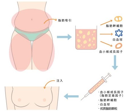 青島哪里做吸脂豐胸效果好