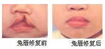 先天性兔唇要如何整形