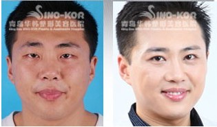 謝磊冷光牙齒美白前后對(duì)比照片
