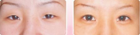 李小姐內(nèi)眥贅皮手術(shù)矯正前后對(duì)比照片
