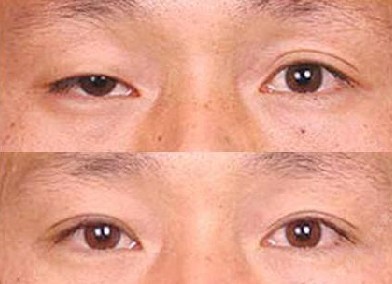 上瞼下垂矯正前后對比照片