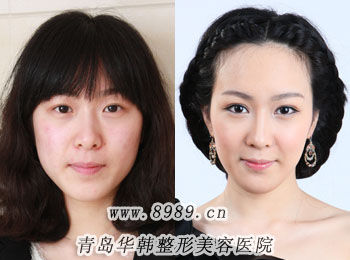 蘇曉蕾做外切眼袋整形手術(shù)成功前后對比照片