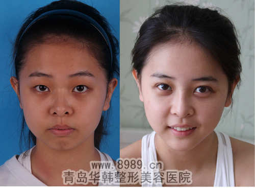 陳瑛墊下巴整形前后對(duì)比照片