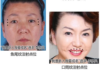 李東風(fēng)面部注射除皺效果圖