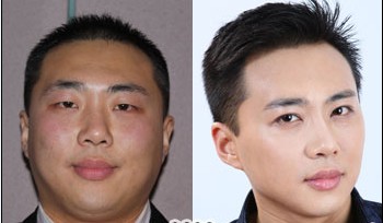 謝磊注射瘦臉前后對比照片