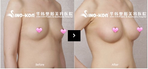 三維水滴隆胸前后對比照片