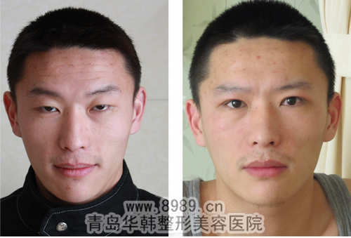 陽光自身脂肪臉頰填充前后對(duì)比照片