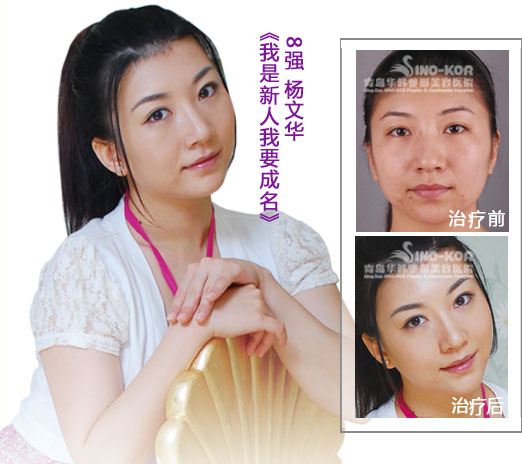 楊文華光子祛痘前后對比照片