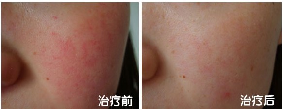 賽諾秀祛紅血絲前后對(duì)比照片