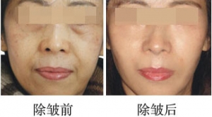 像素激光除皺前后對(duì)比照片