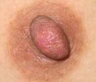 乳頭縮小整形前后對比照片