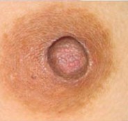 乳頭縮小整形前后對比照片