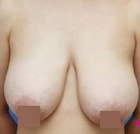 巨乳縮小整形前后對比照片