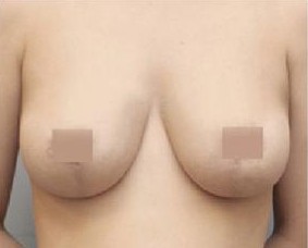 巨乳縮小整形前后對比照片