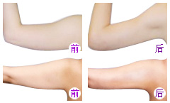 手臂吸脂前后對比照片