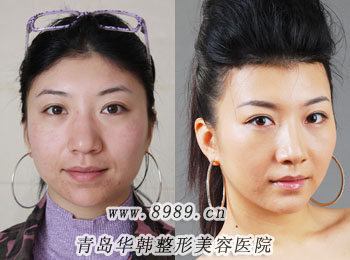 楊文華做高顴骨整形前后對(duì)比照片