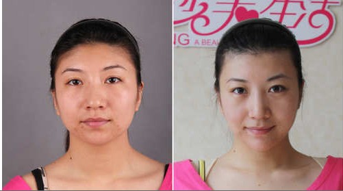 楊文華做顴骨內(nèi)推整形前后對(duì)比照片