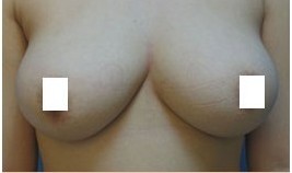巨乳縮小整形前后對(duì)比照片