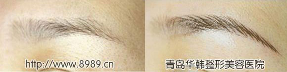 紋眉前后對比照片