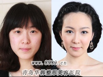 注射隆鼻有什么危害