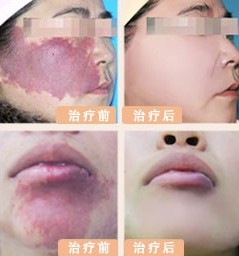 紅胎記對(duì)比