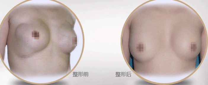 自體脂肪隆胸
