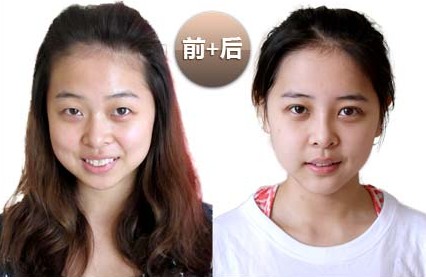 下頜角整形對(duì)比照