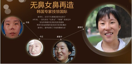 無(wú)鼻女再造鼻專題圖