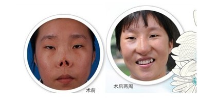 徐壽紅鼻部再造手術(shù)前后對(duì)比圖
