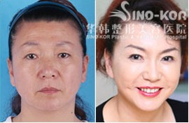 李東風(fēng)除皺前后對(duì)比照