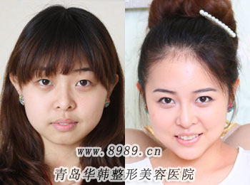 下頜角肥大整形對(duì)比圖