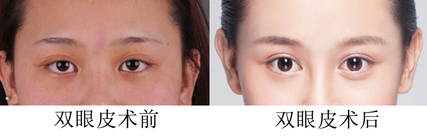 雙眼皮整形效果前后對(duì)比圖