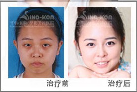 嫩膚效果前后對比圖