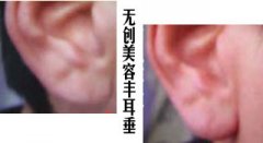 耳垂整形效果前后對(duì)比