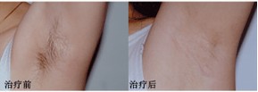脫毛效果前后對比