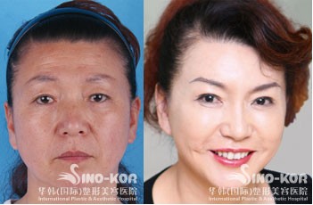 除皺美容效果前后對(duì)比