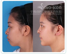 假體隆鼻整形效果前后對(duì)比