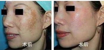 黃褐斑治療效果前后對(duì)比圖