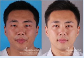 吸脂塑型效果前后對比圖