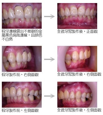 全瓷牙美容修復(fù)效果前后對比圖