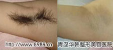冰點脫毛對比照