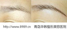 紋眉對比照